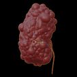 7.jpg 3D Model of Polycystic Kidney