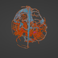 uv10.png 3D Model of Brain Arteriovenous Malformation