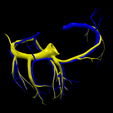 13.png 3D Model of Partial Anomalous Pulmonary Venous Connection