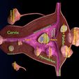 siga12.jpg Fibroid Uterus Human female 3D