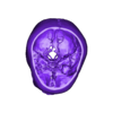 OBJ - MCA Aneurysm.obj 3D Model of Middle Cerebral Artery (MCA) Aneurysm