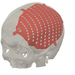 1.jpg Fichier STL PLAQUE CRÂNIENNE FABRIQUÉE SELON LE DÉFAUT・Modèle à télécharger et à imprimer en 3D