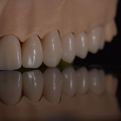 IMG_7762.jpg 3D file Phantom dental model with single crowns and bridges・3D printing idea to download