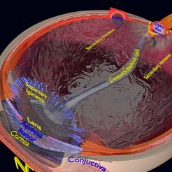 cataract0723.jpg Файл STL Подробно описаны типы 3D линз для лечения катаракты глаз・3D-печатная модель для загрузки