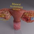 image-0035.jpg Krukenberg ovarian cancer tumor