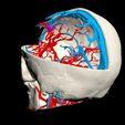 i4.jpg 3D Model of Brain Arteriovenous Malformation