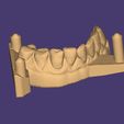Clipboard-2024-06-11-19-27-53.jpg DIGITAL FLIPPER  (Tooth 12) - 4stl. files :  base + artificial tooth +3D models FLEXIBLE