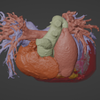 5.png 3D Model of Human Heart with Patent Ductus Arteriosus (PDA) - generated from real patient