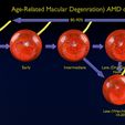 md8423.jpg Age-related macular degeneration AMD ARMD detailed labelled