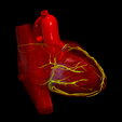 22.png 3D Model of Heart with Tetralogy of Fallot (ToF)