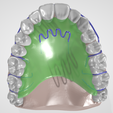 teeth,-dental,-habit-breaker,-incisor,-habit-breaking,-orthodontics,-oral,-canines,-premolar,-molar,.png High resolution Habit Breaker Two Dental Appliance on Upper teeth