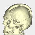 skull-2.jpg Skull-cranial defect