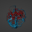 w11.png 3D Model of Brain Arteriovenous Malformation