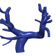 chd1.png.5368260a2188e7a85c688980d16bca8e.png 3D Model of Pulmonary Arteries (Fontan Procedure)