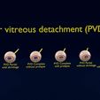 posterior-vitreous-detachment-types-eye-3d-model-blend-84.jpg Posterior vitreous detachment types eye 3D model