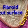 0007.jpg Fibroid Uterus Human female 3D