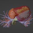 6.png 3D Model of Human Heart with Transposition of Great Arteries (TGA) - generated from real patient