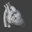 5.jpg 有心房间隔缺损的心脏 3D 模型