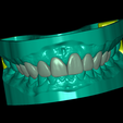 front.png Dental Model With 10 Veneers and Articulator
