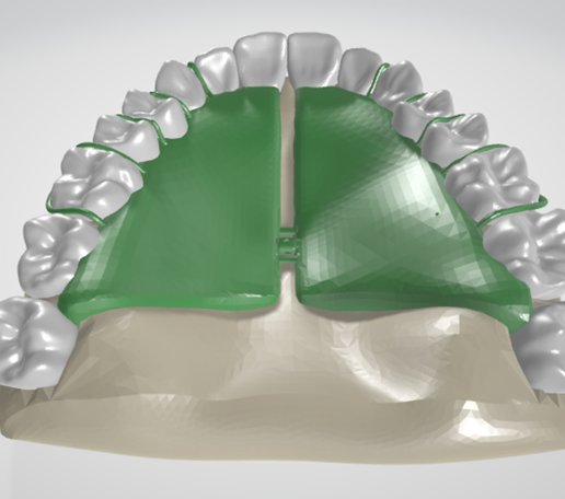 Removable-Palatal-Expansion-Appliance,-molar-distalizer,-teeth,-dental,-tooth,-palatal-expander,-app.png Aparato de Expansión Palatal Removible (KDE) en Dientes Superiores Aparato Dental