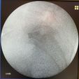 61_Rg_AFTER.jpeg Cage ALIF- Anterior Lumbar Interbody Fusion (real operation)