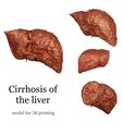 3D53A8C0-3B73-4438-A329-FFE3C188225A.jpeg Anatomical model of the liver with cirrhosis