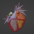 8.png 3D Model of Human Heart with Common Arterial Trunk (CAT) - generated from real patient
