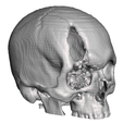 Captura-de-Pantalla-2023-08-22-a-la-s-6.36.11-p. m.png skull fracture / skull fracture