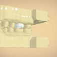 untitled.59.jpg Digital Dental Quadrant  Model with a Full Contour Crown