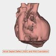 4.jpg congenital heart disease classification ( CHD )