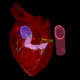 2.png 3D Model of Heart wirh Atrioventricular Septal Defect, 4 chamber view