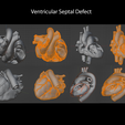 2.VSD2.png Congenital Heart Disease - 7pack