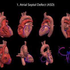 1.ASD.png Maladies cardiaques congénitales - Paquet de 7