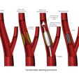 Peripheral Artery Intervention-00.JPG 3d printable Carotid artery stenting procedure diorama 3D print model
