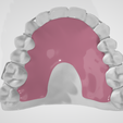 Standard-Hawley-dental-appliance-1.png High resolution Standard Hawley Dental Appliance