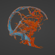 uv9.png 3D Model of Brain Arteriovenous Malformation