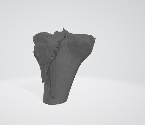 2.jpg Fracture of proximal extremity of tibia