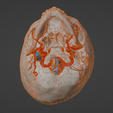 uv5.png 3D Model of Brain Arteriovenous Malformation