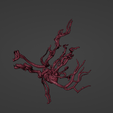 t9.png 3D Model of Middle Cerebral Artery (MCA) Aneurysm