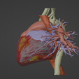 3.png 3D Model of Human Heart with Atrial Septal Defect (ASD) - generated from real patient