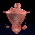 0021.jpg Fibroid Uterus Human female 3D