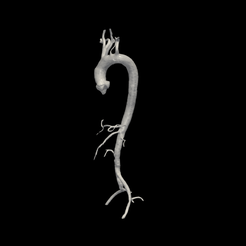 1.png 3D Model of Aorta and Aortic Vessel Tree - generated from real patient