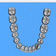 Dentes-Mandibula-Ashortia-Exocad-02.jpg Teeth mandibule - Ashortia - Exocad