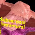 0013.jpg Fibroid Uterus Human female 3D