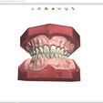 5.jpg Digital Full Dentures for Gluedin Teeth with Manual Reduction
