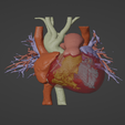 1.png 3D Model of Human Heart with Atrial Septal Defect (ASD) - generated from real patient