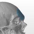 cranio-4.jpg A cranial plate to replace a skull defect (an example of a real operation 2)