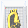 7.png 3D Model of Aorta and Coronary Arteries