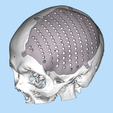 Capture.png CRANIAL PLATE MADE ACCORDING TO DEFECT