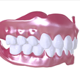 9.png Digital Full Dentures with Combined Glue-in Teeth Arch